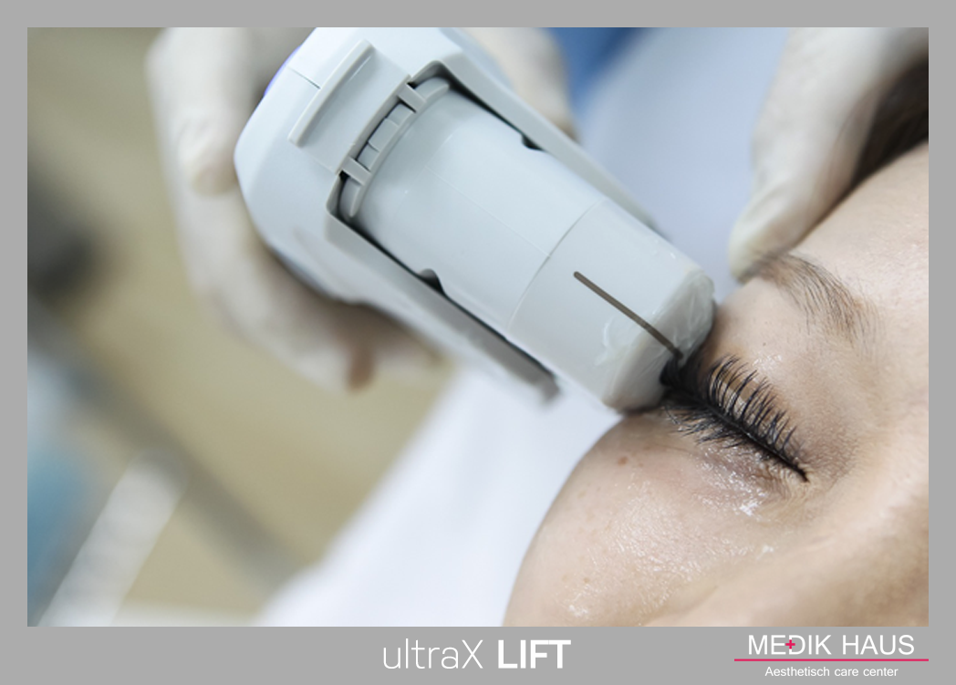 Lifting UltraX lift je moderní a šetrný lifting.