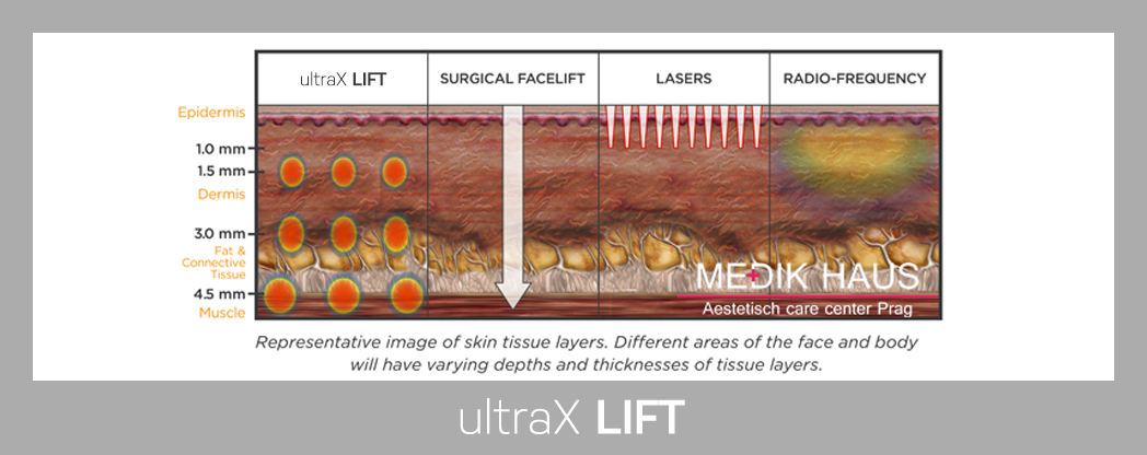 Šetrný a neinvazivní lifting UltraX lift.