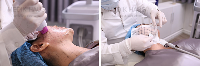 lifting Thermo Anti-Age FX je šetrný a neinvazivní.