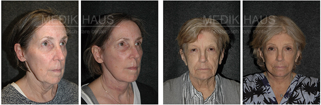 Nebojte se změny s liftingem Thermo Anti-Age FX.