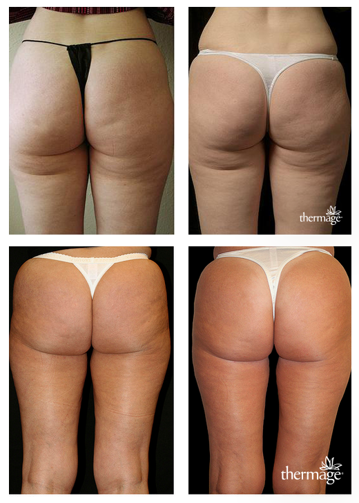 Lifting celého těla Thermo Anti-Age total tip vám dopřeje konečně viditelnou změnu.